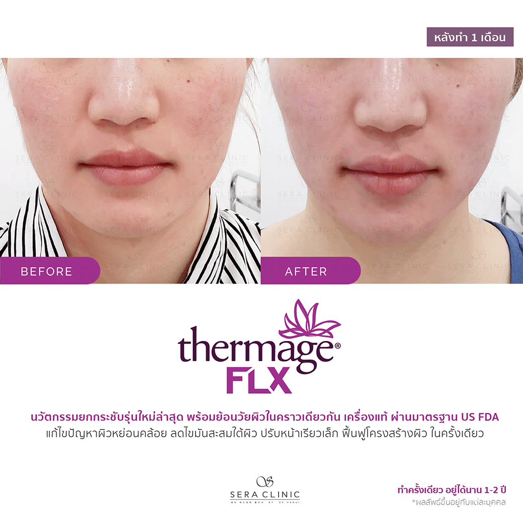 review รีวิว ยกกระชับผิว หน้าเรียว thermage flx