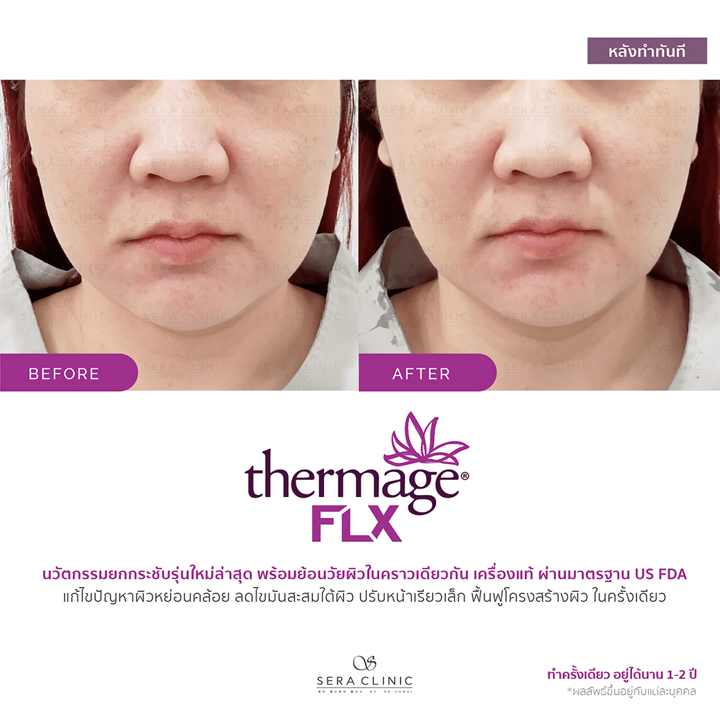 review รีวิว ยกกระชับผิว หน้าเรียว thermage flx