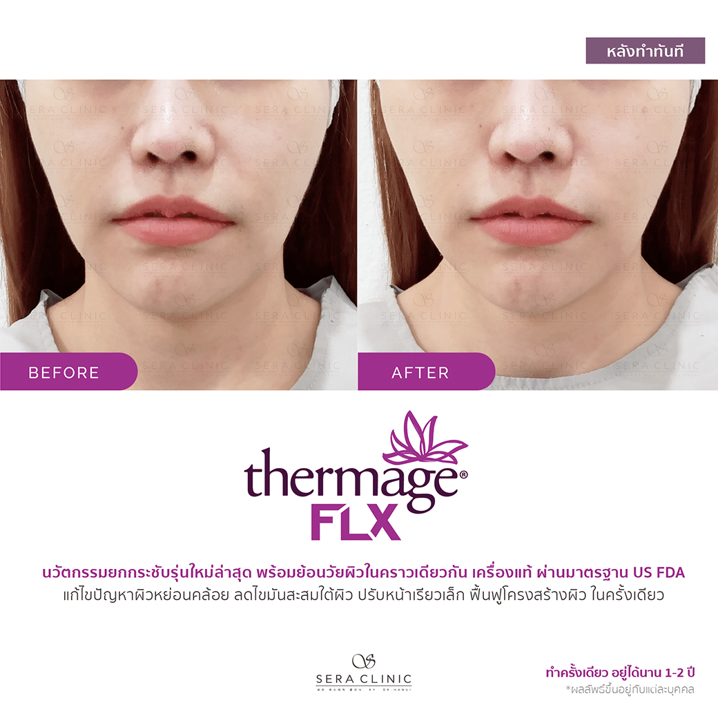 review รีวิว ยกกระชับผิว หน้าเรียว thermage flx