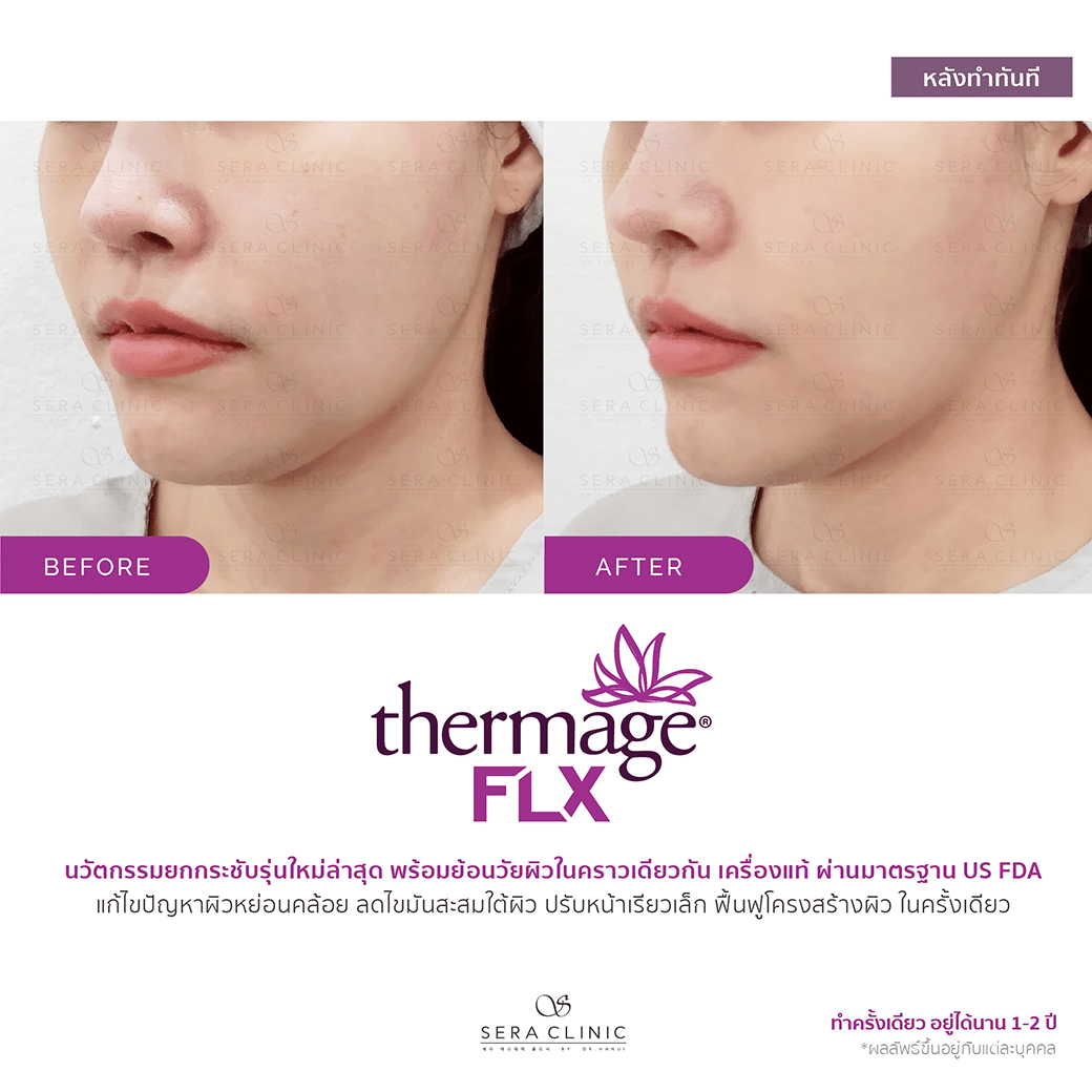 review รีวิว ยกกระชับผิว หน้าเรียว thermage flx