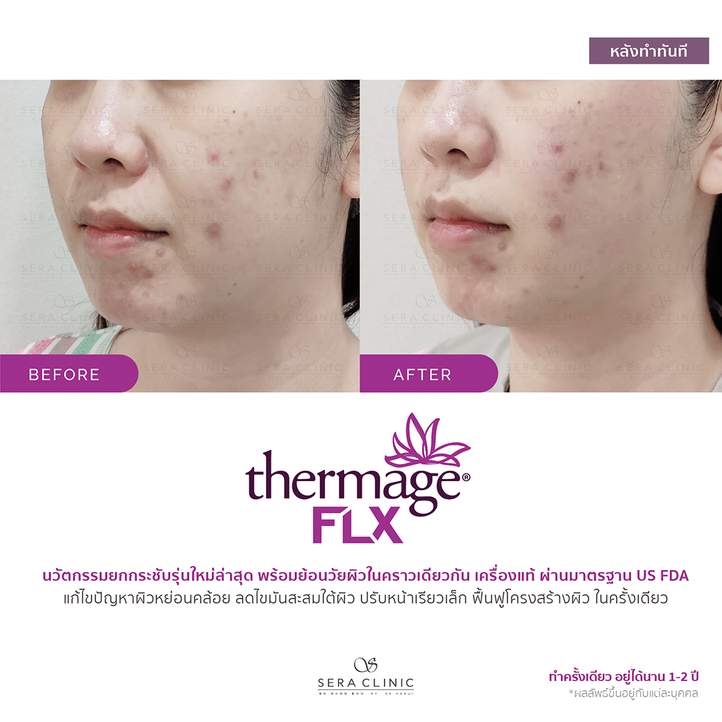 review รีวิว ยกกระชับผิว หน้าเรียว thermage flx