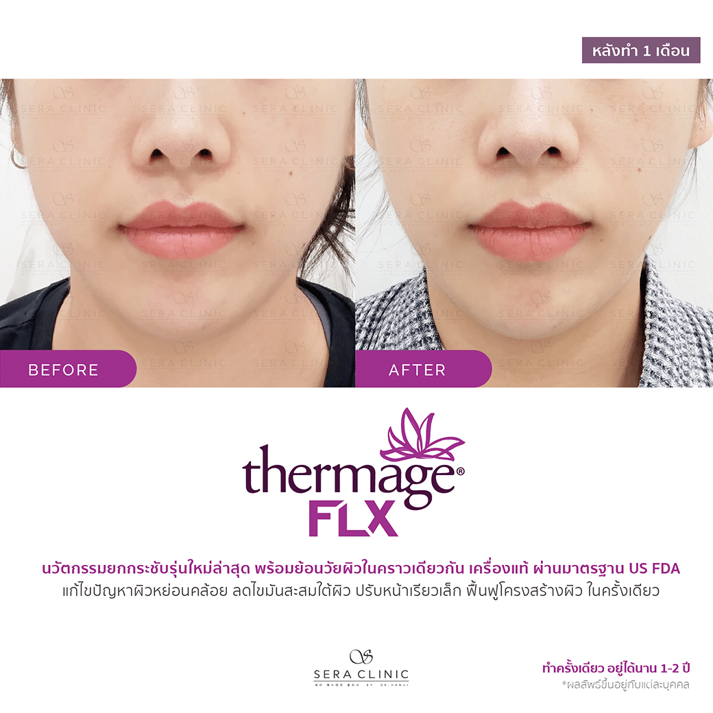 review รีวิว ยกกระชับผิว หน้าเรียว thermage flx