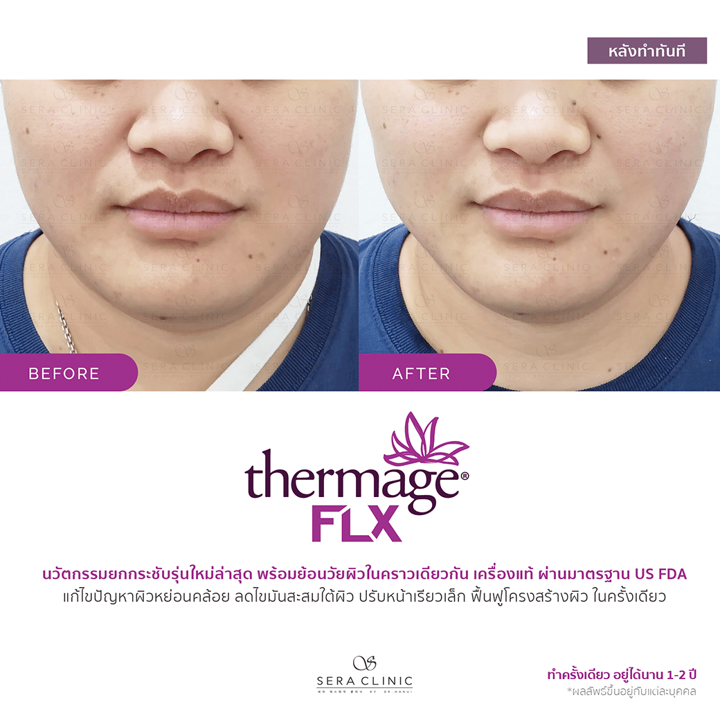 review รีวิว ยกกระชับผิว หน้าเรียว thermage flx