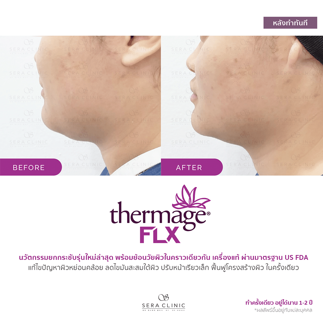 review รีวิว ยกกระชับผิว หน้าเรียว thermage flx