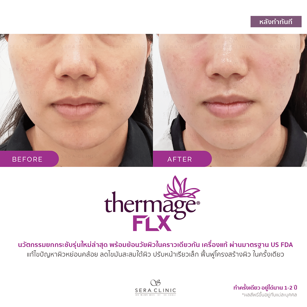 review รีวิว ยกกระชับผิว หน้าเรียว thermage flx