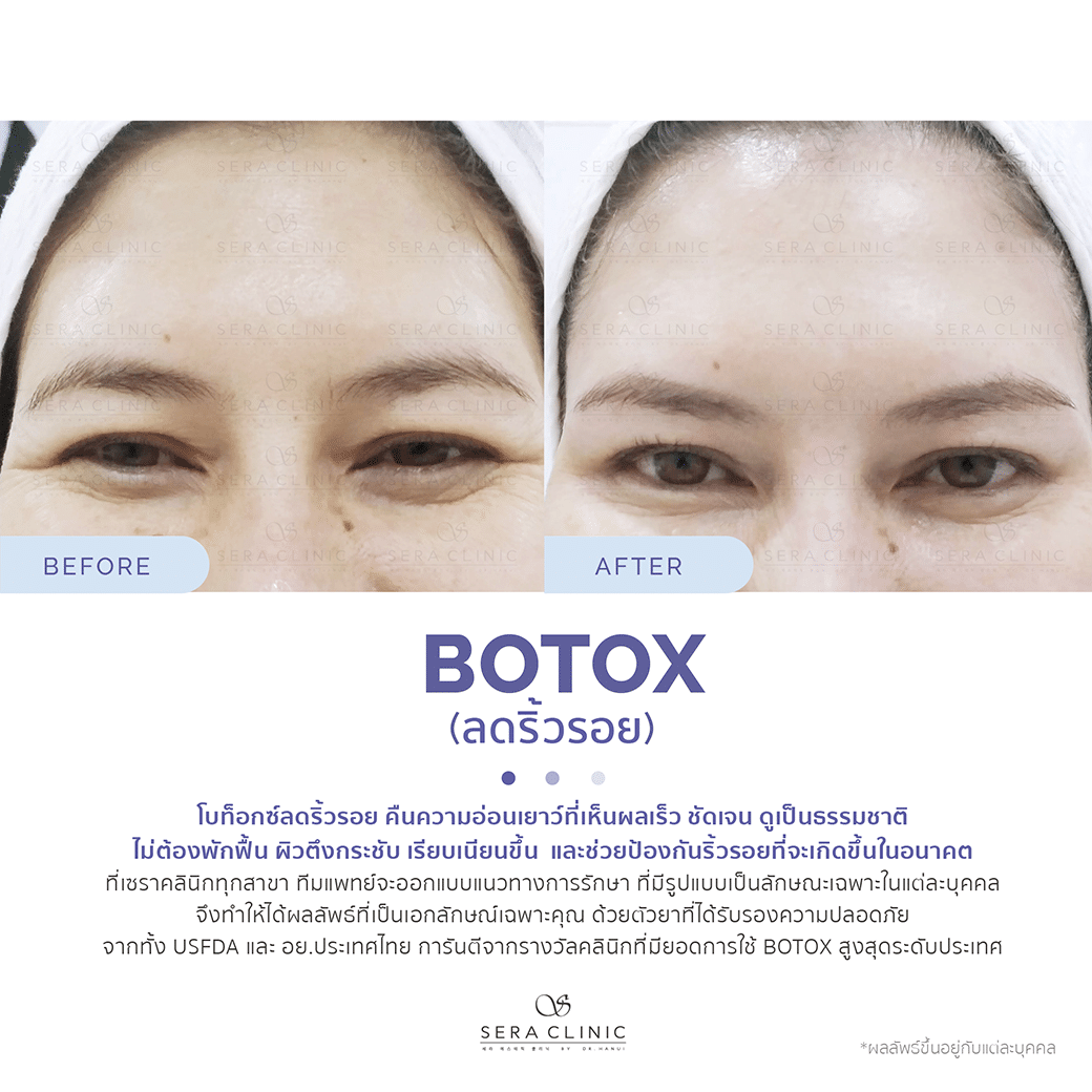 review รีวิว โบท็อกซ์ (Botox) ลดริ้วรอย ดูอ่อนเยาว์ ปรับรูปหน้า ปลอดภัย เซราคลินิก Sera Clinic