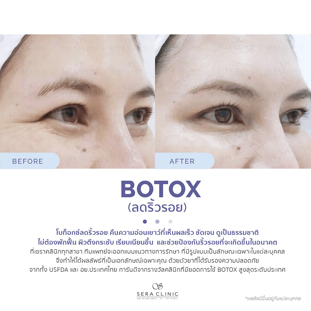 review รีวิว โบท็อกซ์ (Botox) ลดริ้วรอย ดูอ่อนเยาว์ ปรับรูปหน้า ปลอดภัย เซราคลินิก Sera Clinic