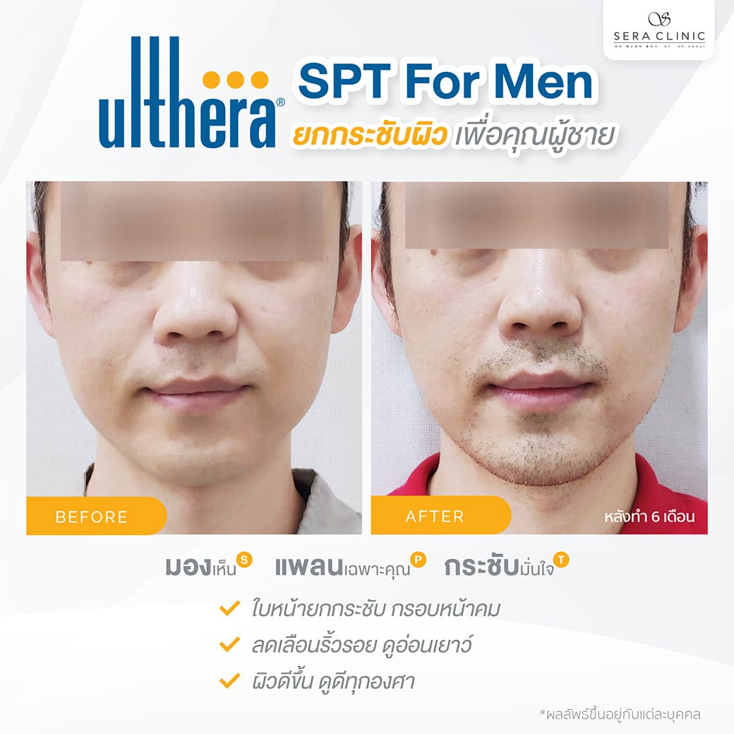 ultherapy SPT for men ยกกระชับผิว ลดริ้วรอย ปรับรูปหน้าเรียว ลดเหนียงultherapy SPT ยกกระชับผิว ลดริ้วรอย ปรับรูปหน้าเรียว ลดเหนียง หล่อคม กรอบหน้าชัด ทุกองศา เพื่อคุณผู้ชาย