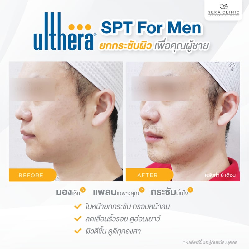 ultherapy SPT for men ยกกระชับผิว ลดริ้วรอย ปรับรูปหน้าเรียว ลดเหนียงultherapy SPT ยกกระชับผิว ลดริ้วรอย ปรับรูปหน้าเรียว ลดเหนียง หล่อคม กรอบหน้าชัด ทุกองศา เพื่อคุณผู้ชาย