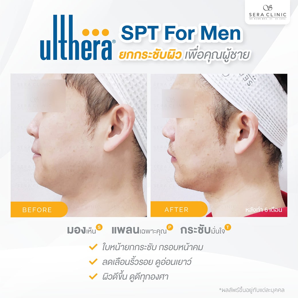 ultherapy SPT for men ยกกระชับผิว ลดริ้วรอย ปรับรูปหน้าเรียว ลดเหนียงultherapy SPT ยกกระชับผิว ลดริ้วรอย ปรับรูปหน้าเรียว ลดเหนียง หล่อคม กรอบหน้าชัด ทุกองศา เพื่อคุณผู้ชาย