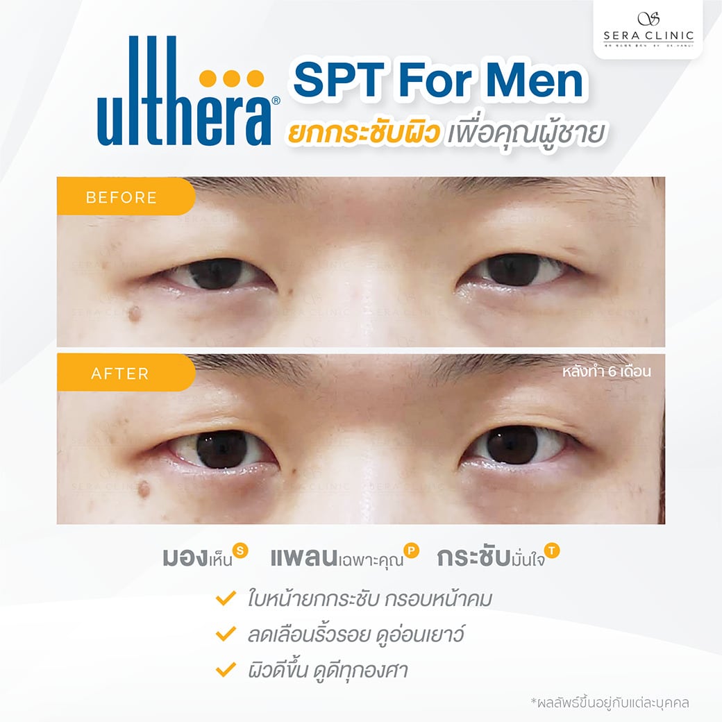 ultherapy SPT for men ยกกระชับผิว ลดริ้วรอย ปรับรูปหน้าเรียว ลดเหนียงultherapy SPT ยกกระชับผิว ลดริ้วรอย ปรับรูปหน้าเรียว ลดเหนียง หล่อคม กรอบหน้าชัด ทุกองศา เพื่อคุณผู้ชาย