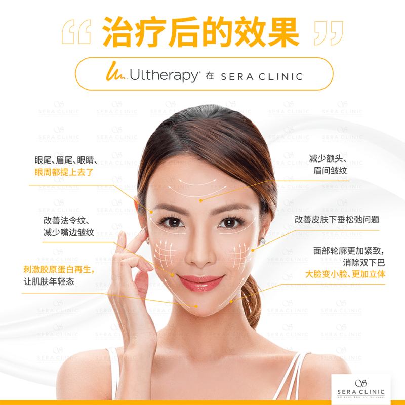 Ultherapy SPT 最会提升皮肤的科技Ultherapy SPT 最会提升皮肤的科技 淡化皱纹 紧致脸部轮廓线条 不用手术