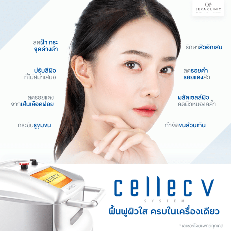 Cellec V IPL เลเซอร์เคลียร์ผิวให้หน้าใสอีกครั้ง ด้วยนวัตกรรมใหม่ล่าสุดของ IPL จากเกาหลี