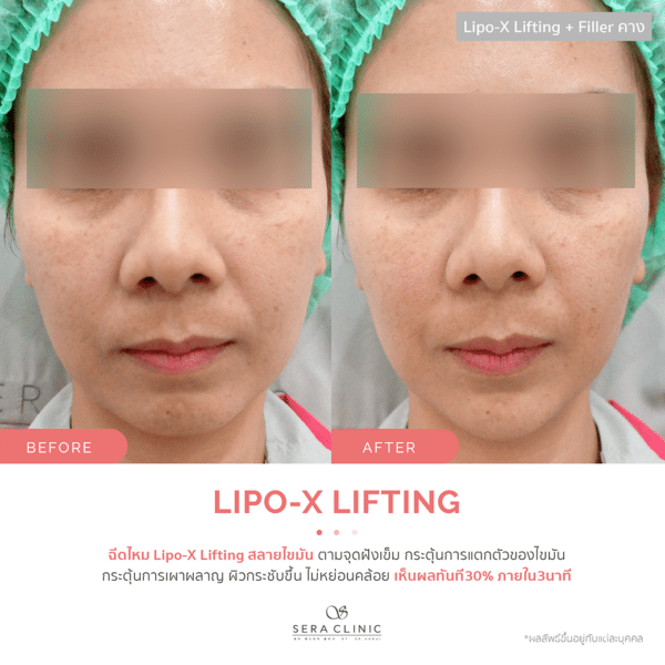 Sera Clinic เซรา คลินิก before and after Lipo-X Lipo-TOX Lifting ฉีดแฟต สลายไขมัน เมโสแฟต meso fat ยกกระชับ ลดไขมันSera Clinic before and after Lipo-X Lipo-TOX Lifting ฉีดแฟต สลายไขมัน เมโสแฟต meso fat ยกกระชับ ลดไขมัน