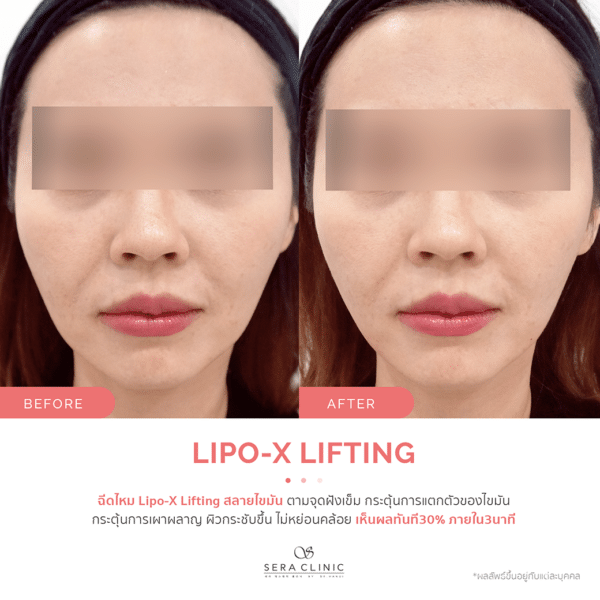 Sera Clinic เซรา คลินิก before and after Lipo-X Lipo-TOX Lifting ฉีดแฟต สลายไขมัน เมโสแฟต meso fat ยกกระชับ ลดไขมันSera Clinic before and after Lipo-X Lipo-TOX Lifting ฉีดแฟต สลายไขมัน เมโสแฟต meso fat ยกกระชับ ลดไขมัน