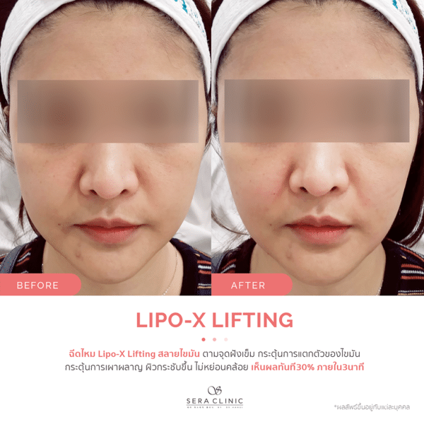 Sera Clinic เซรา คลินิก before and after Lipo-X Lipo-TOX Lifting ฉีดแฟต สลายไขมัน เมโสแฟต meso fat ยกกระชับ ลดไขมันSera Clinic before and after Lipo-X Lipo-TOX Lifting ฉีดแฟต สลายไขมัน เมโสแฟต meso fat ยกกระชับ ลดไขมัน