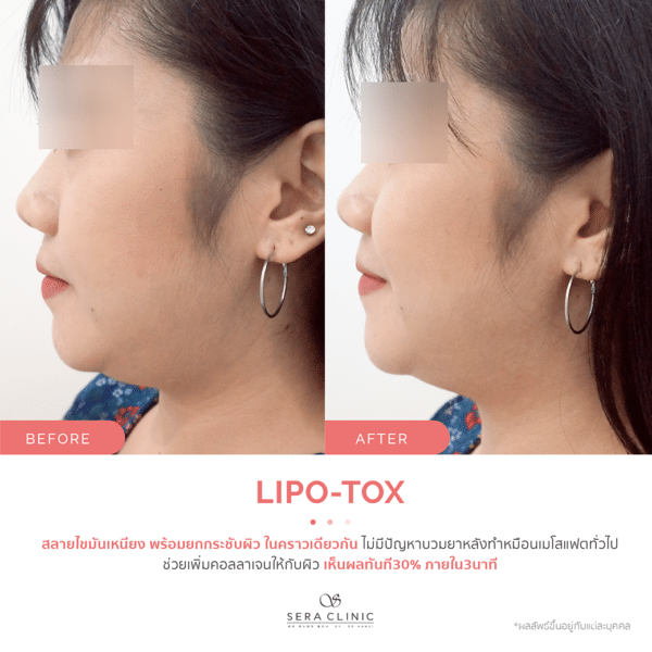 Sera Clinic เซรา คลินิก before and after Lipo-X Lipo-TOX Lifting ฉีดแฟต สลายไขมัน เมโสแฟต meso fat ยกกระชับ ลดไขมันSera Clinic before and after Lipo-X Lipo-TOX Lifting ฉีดแฟต สลายไขมัน เมโสแฟต meso fat ยกกระชับ ลดไขมัน