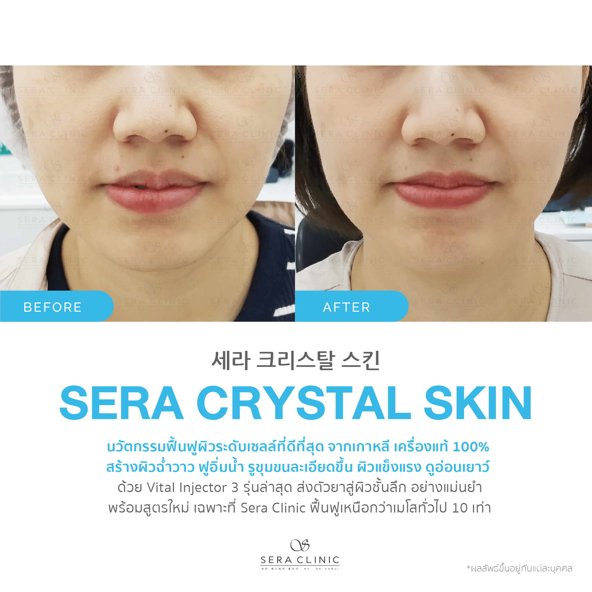 review รีวิว เซราคลินิก Sera Clinic Sera Crystal Skin นวัตกรรมเกาหลีขั้นสูง ฟื้นฟูผิวใส ลึกระดับเซลล์ หน้าฉ่ำวาว