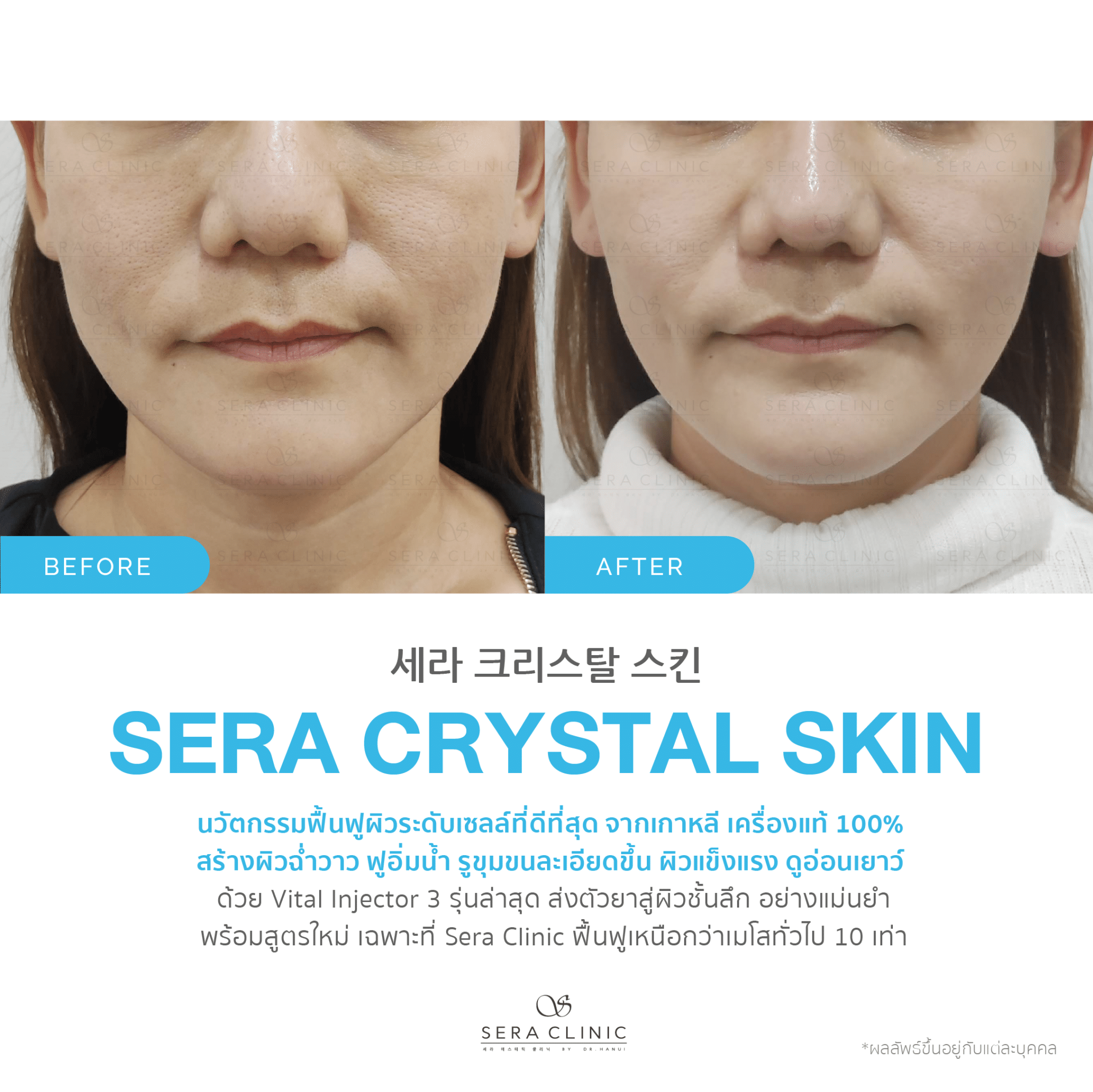 review รีวิว เซราคลินิก Sera Clinic Sera Crystal Skin นวัตกรรมเกาหลีขั้นสูง ฟื้นฟูผิวใส ลึกระดับเซลล์ หน้าฉ่ำวาว