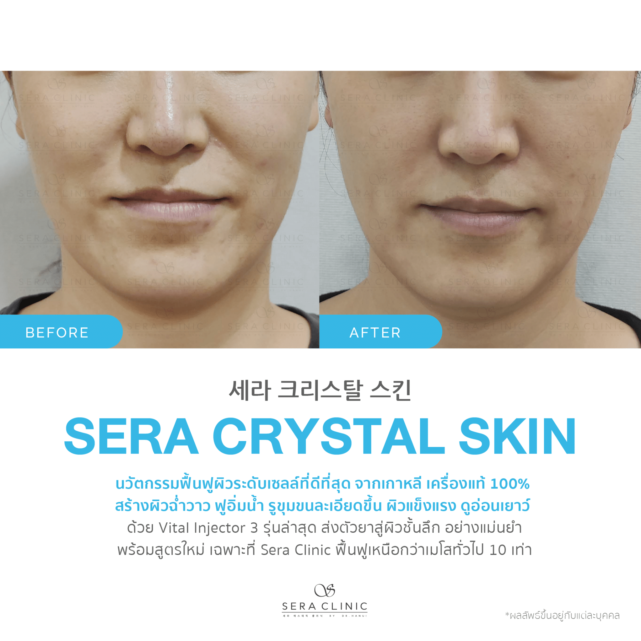 review รีวิว เซราคลินิก Sera Clinic Sera Crystal Skin นวัตกรรมเกาหลีขั้นสูง ฟื้นฟูผิวใส ลึกระดับเซลล์ หน้าฉ่ำวาว