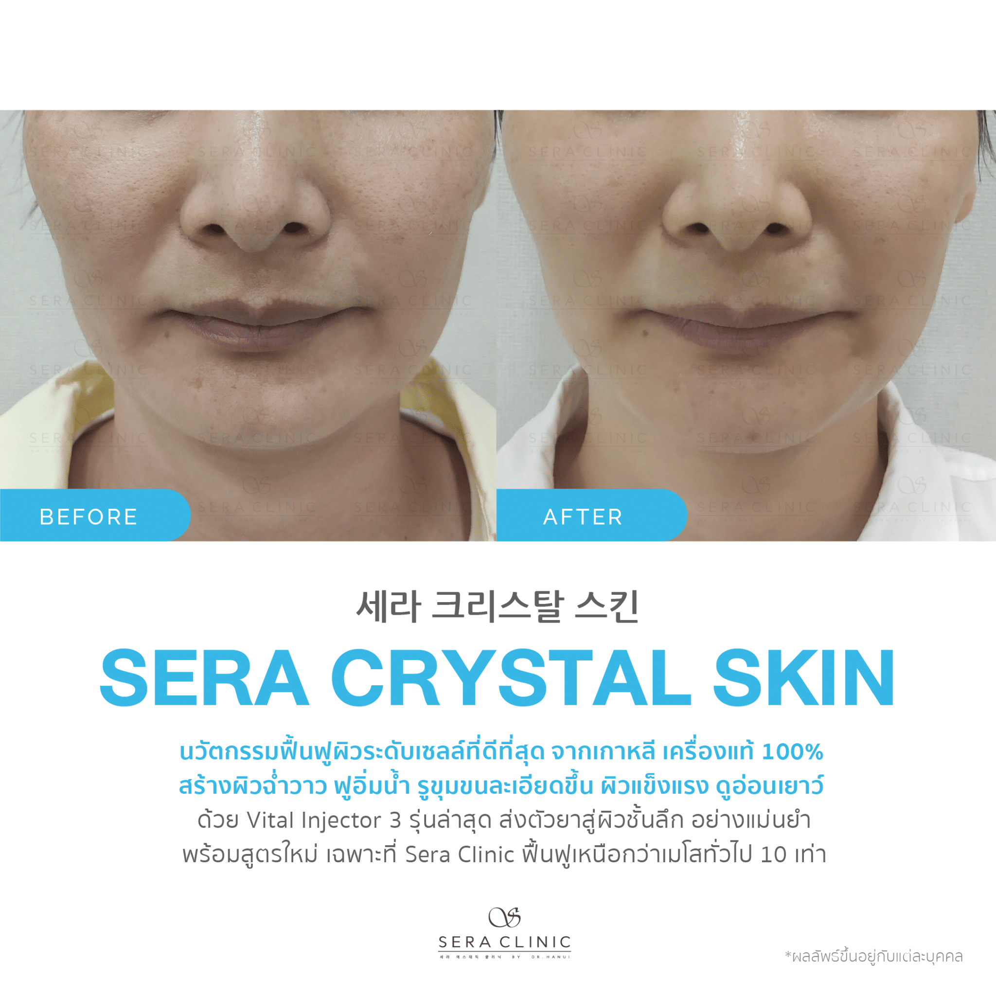 review รีวิว เซราคลินิก Sera Clinic Sera Crystal Skin นวัตกรรมเกาหลีขั้นสูง ฟื้นฟูผิวใส ลึกระดับเซลล์ หน้าฉ่ำวาว