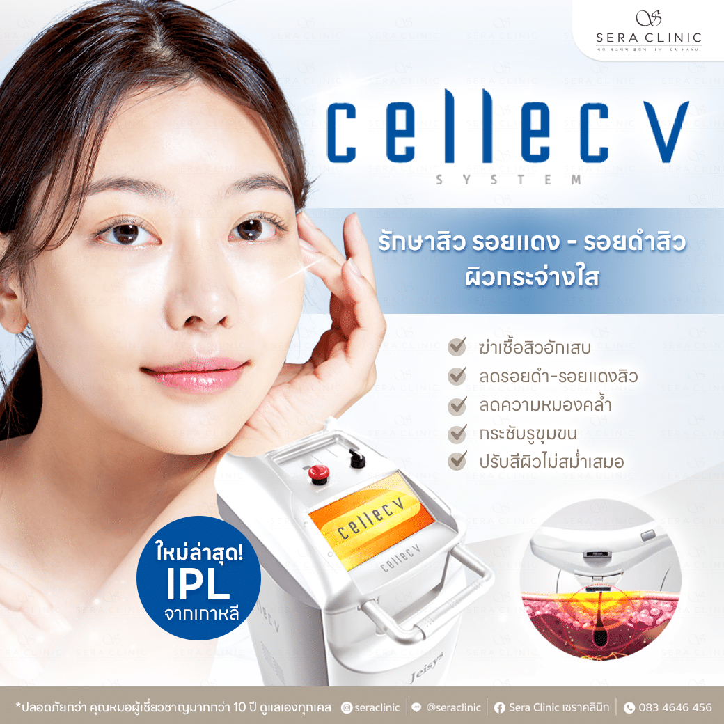 Cellec V IPL เลเซอร์เคลียร์ผิวให้หน้าใสอีกครั้ง รักษาสิว รอยดำ รอยแดง ด้วยนวัตกรรมใหม่ล่าสุดของ IPL จากเกาหลี