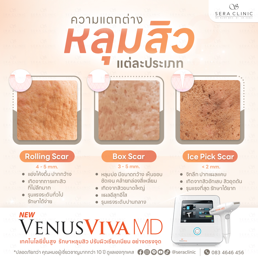 venus viva md ประเภทหลุมสิว ice pick scar , rolling scar , box scar