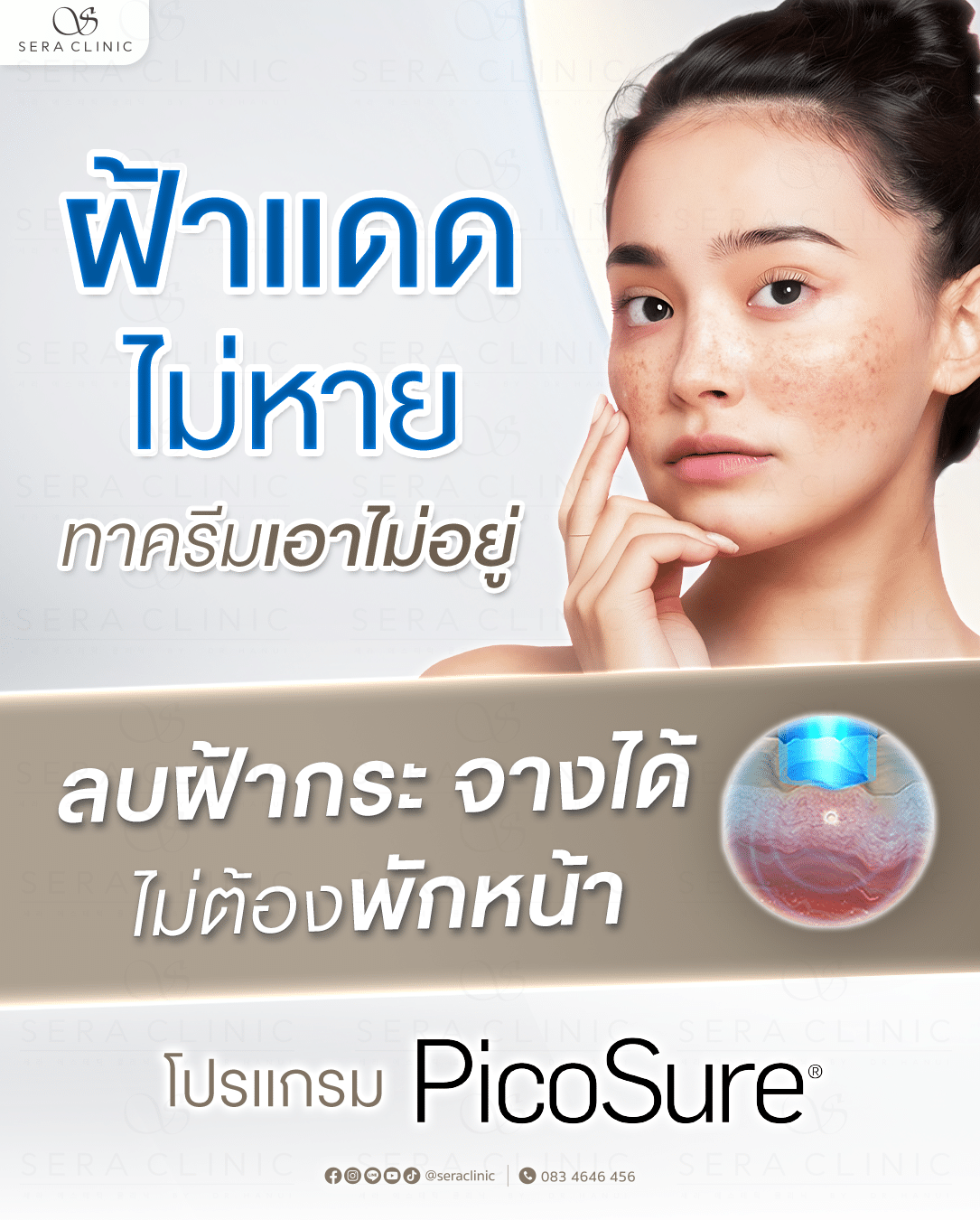 PicoSure เชียงใหม่